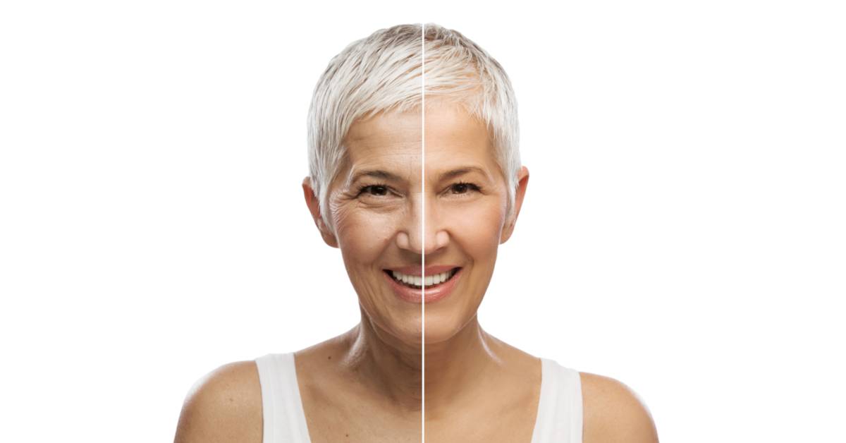 Botox Myths Debunked: Separating Fact from Fiction